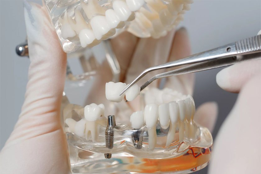 имплантация верхних жевательных зубов