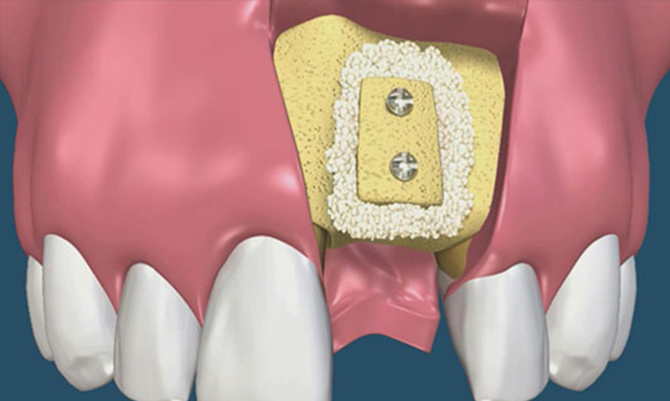костная пластика нижних зубов