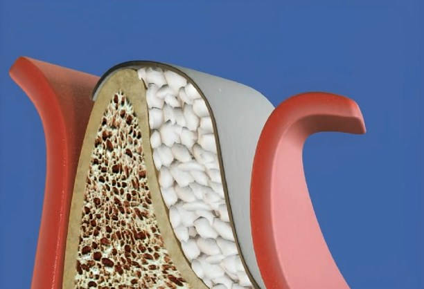Костную пластику нижней челюсти проводят лучшие стоматологи клиники РуДента в Москве. Доступные цены на все виды лечения и диагностики. Наращивание костной ткани на нижней челюсти лучшими материалами! Записывайтесь на прием на сайте стоматологии.