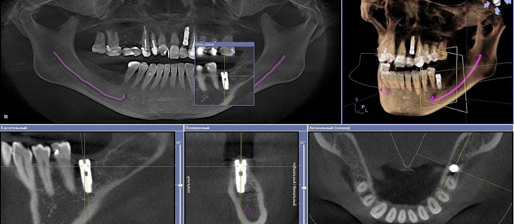 имплантация нижнего жевательного зуба