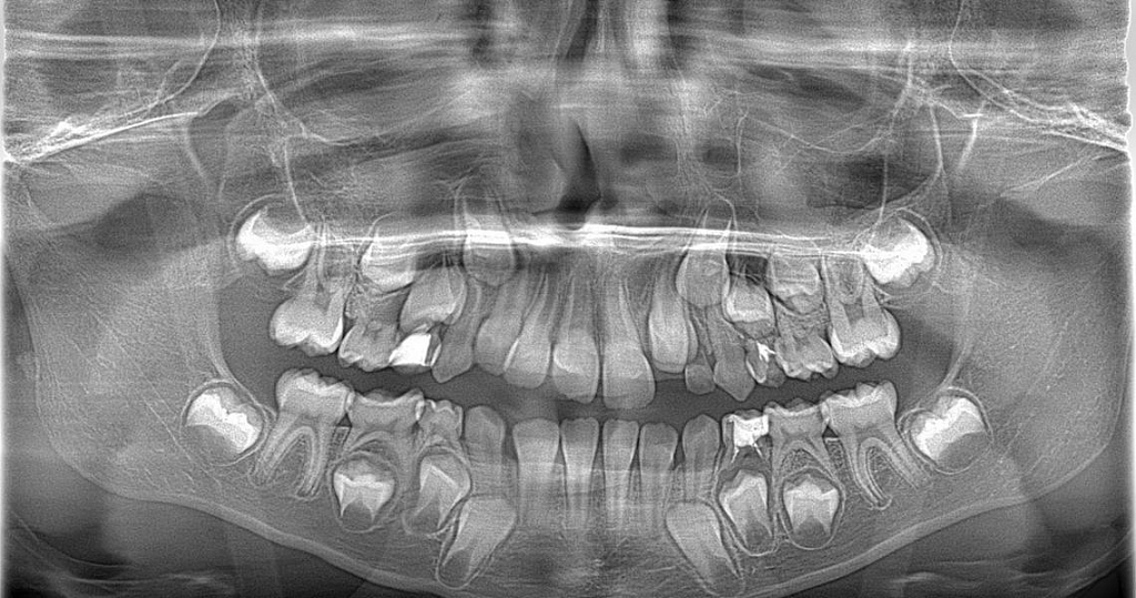 Осложнения после удаления зубов: виды, лечение, профилактика