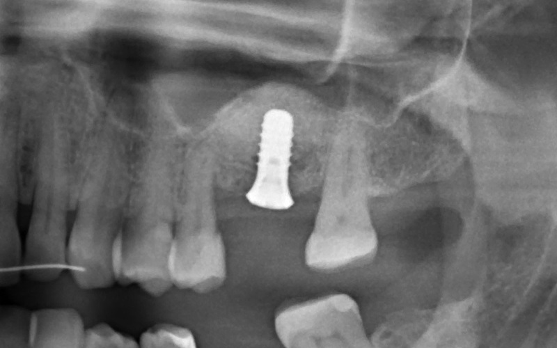 имплантация зуба верхней челюсти