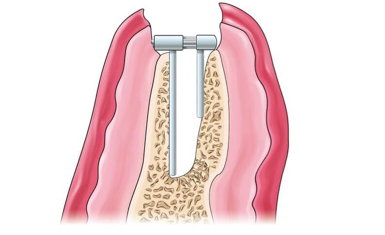 костная пластика при имплантации на нижней челюсти