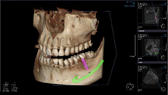 диагностика трещины в корнях зубов