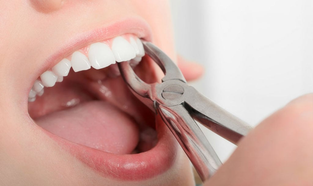 удаление зуба что нужно знать