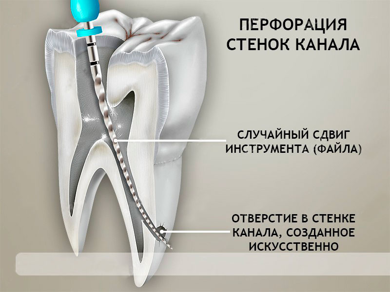 схема лечения зуба