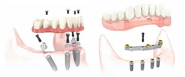 установка зубных протезов