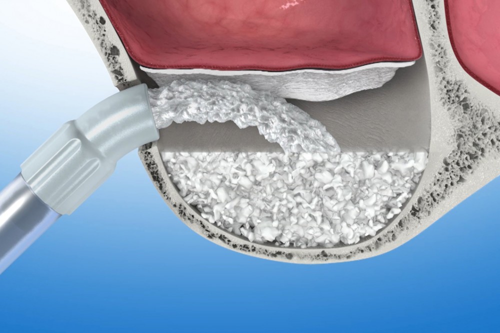 костная пластика нижней челюсти для имплантации