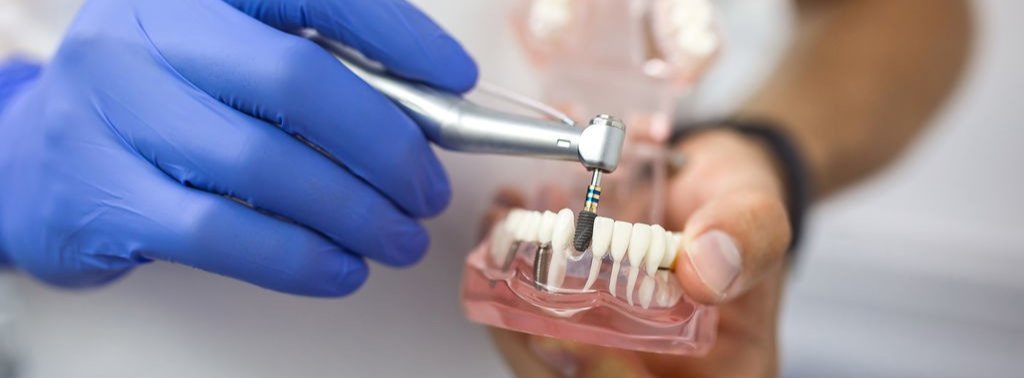 имплантация зубов стоимость москва